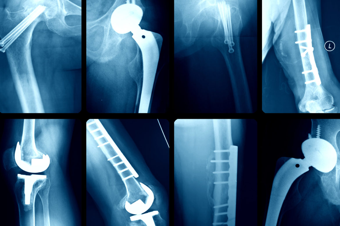 Röntgenaufnahmen diverser Prothesen.