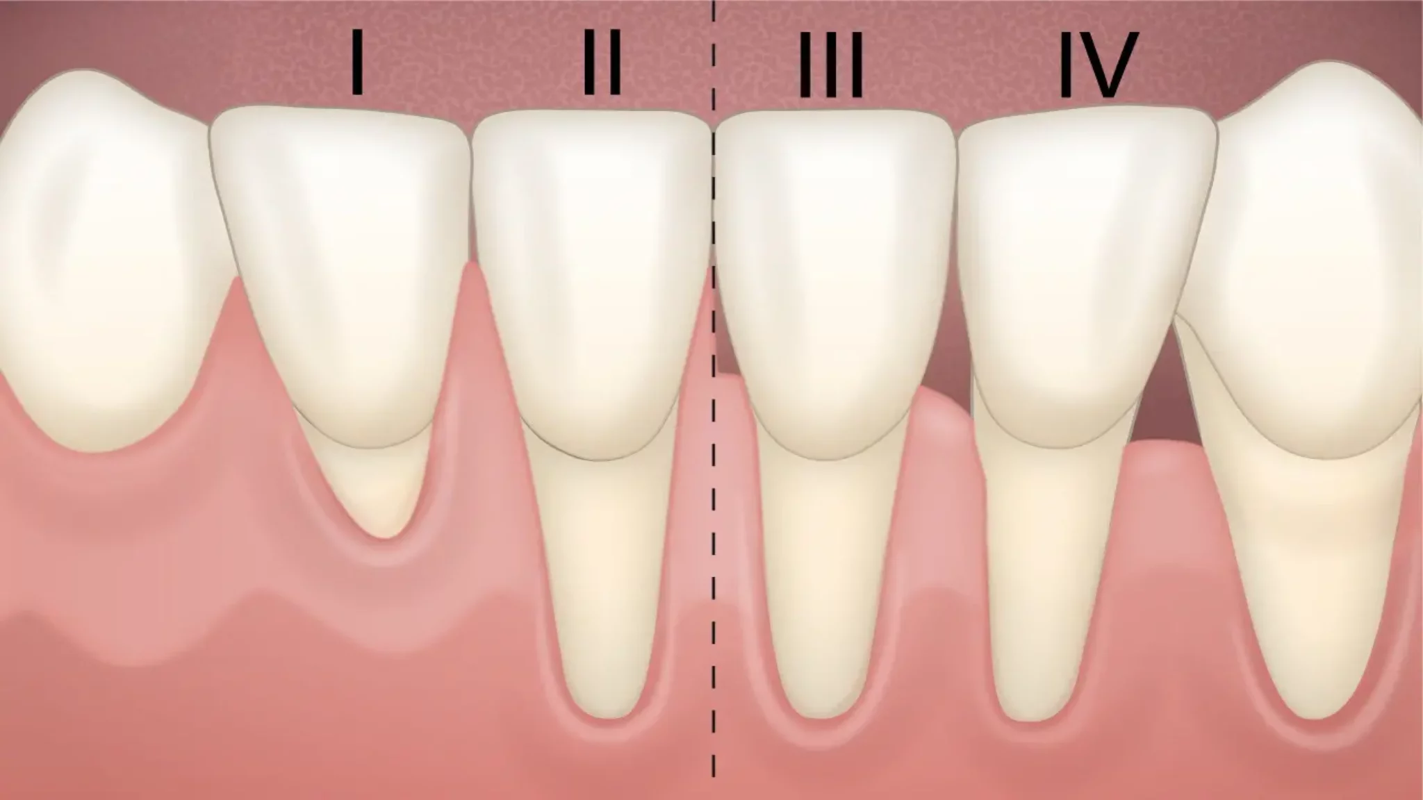 ursache zahnfleischrückgang, Die Ursache von Zahnfleischrückgang